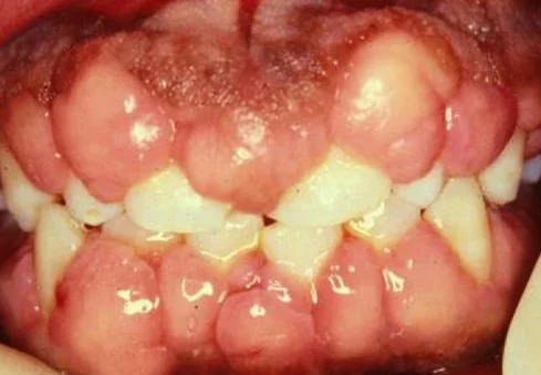 The gingival hyperplasia struggle is real. Image
