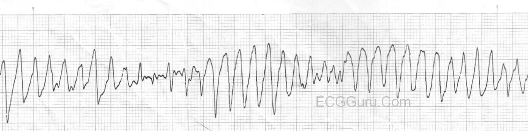 It looks sort of like a party streamer. But Torsades de Pointes is a medical emergency. ( Image )