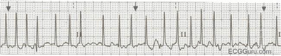 Afib with RVR ( Image )