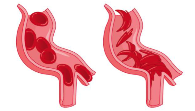 An image of sickled cells resulting in blockages ( Image )