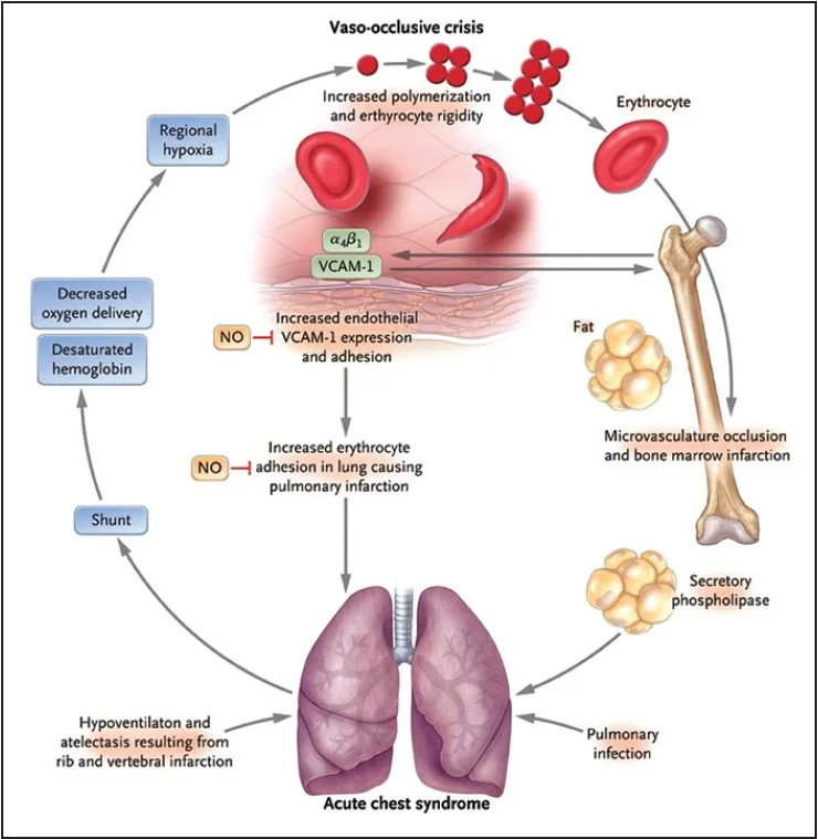 ( Image ) Pathophysiology of ACS and vaso-occlusive pain crises