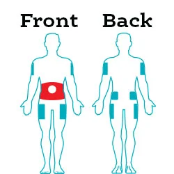 Red infusion sites are preferred. Teal sites are alternatives. (Image)