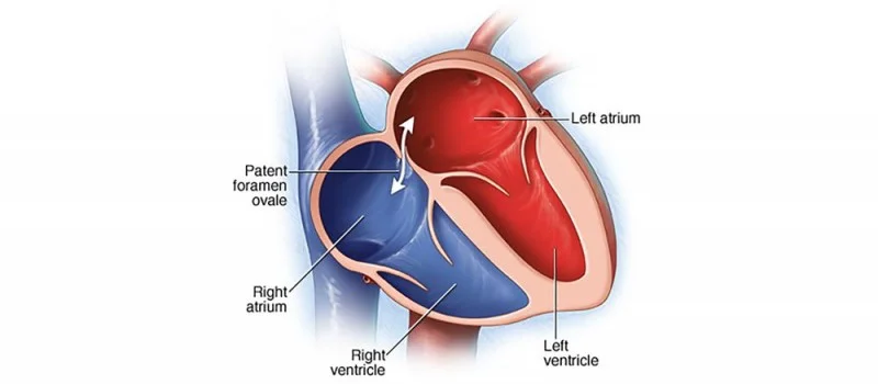 A patent foramen ovale (PFO) allows blood to bypass the net-like pulmonary circuit when going from the right-hand, venous system to the left-hand, arterial system. This is one way that a VTE can lead to a stroke. (Image)