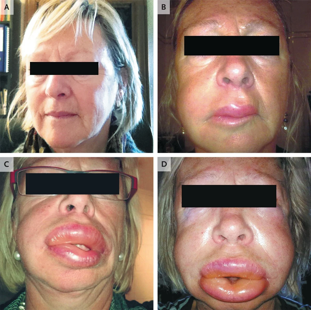 One example of facial angioedema progression. (Image)