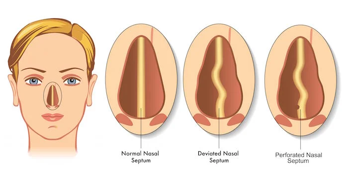 The non-gross Google image of septal perforation. But you can imagine the complications of having wear and tear in the tissue between your nostrils… (Image)