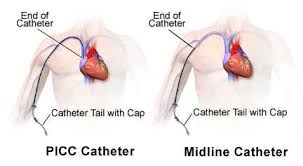 PICCs (Peripherally Inserted Central Catheters) are common central access devices. Note that the tip of the catheter is all the way in the superior vena cava (aka a large, high flow vessel). Contrast this with a midline, which ends in a peripheral location (aka a smaller vessel that can not handle total PN). However, peripheral parenteral nutrition (or PPN) may be an option through a midline given its less robust osmolality compared to total PN. (Image)