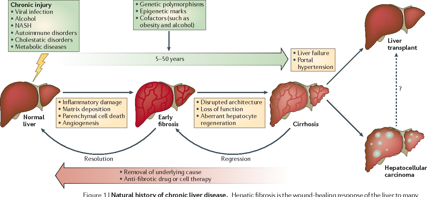 The spectrum of liver fibrosis. Note how early fibrosis can be resolved, whereas more severe fibrosis/cirrhosis can only be managed. ( Image )