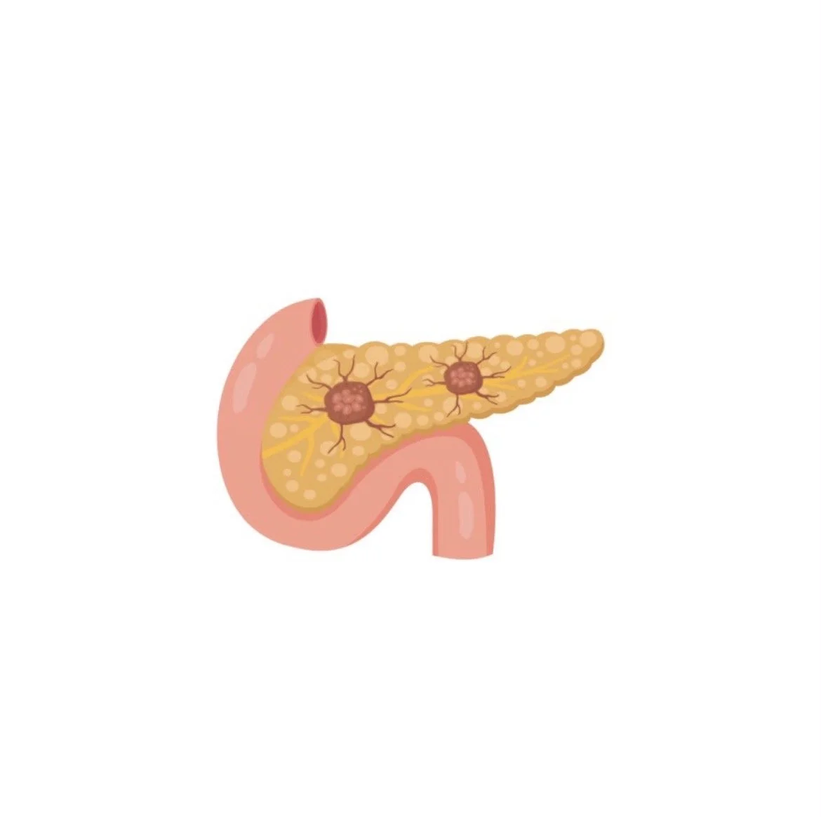 The tl;dr Pharmacy Journal Club: Daraxonrasib in Metastatic Pancreatic Cancer - The RASolute 302 Trial