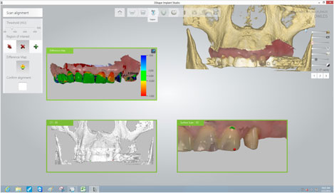 Este es un proceso que analiza la estructura ósea y nerviosas ubicaciones de los pacientes mediante la combinación de la imagen panorámica y las imágenes de escáner 3D por vía oral.
