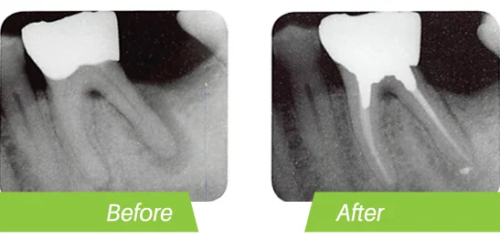 root-canal-before-after.jpg