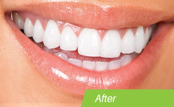 teeth-whitening-after.jpg