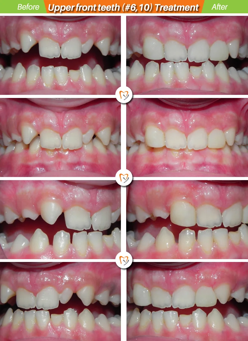 Upper-front-teeth.jpg