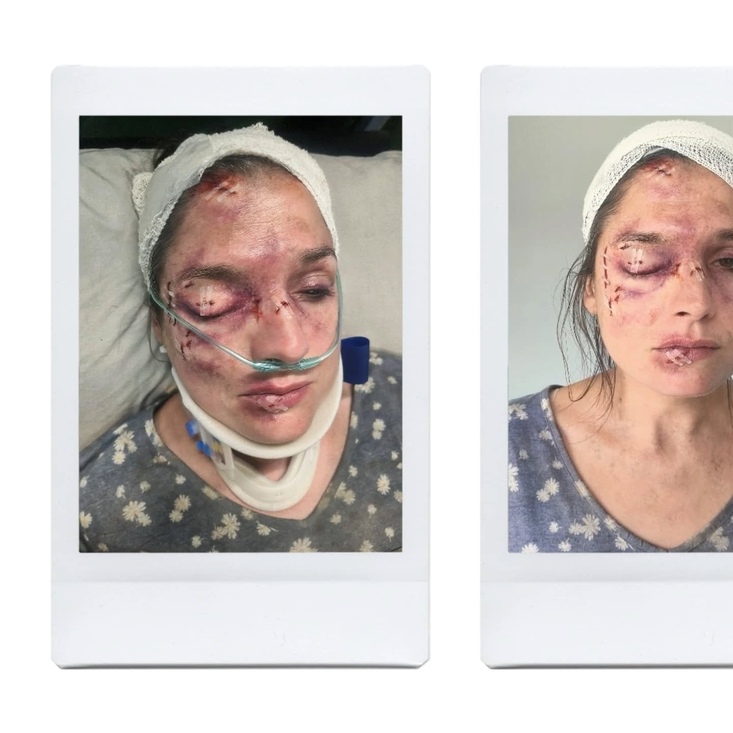 It was thrilling and incredibly rewarding to be able to lead the prosthetics of The Rig S2.  This is one of my favourite makeups from the show - which are the injuries that Casey gets during the tsunami, I wanted her eye to be a little swollen and cl