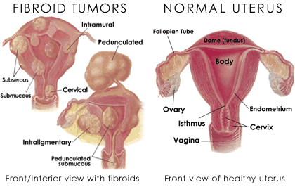 Uterine Fibroids after Menopause