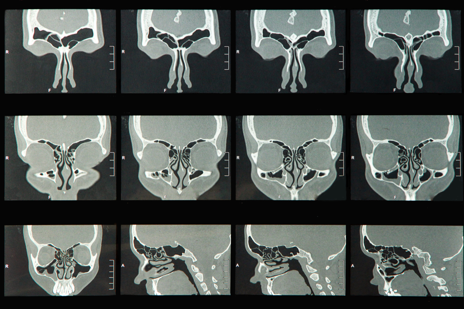 Nasal Polyps Surgery