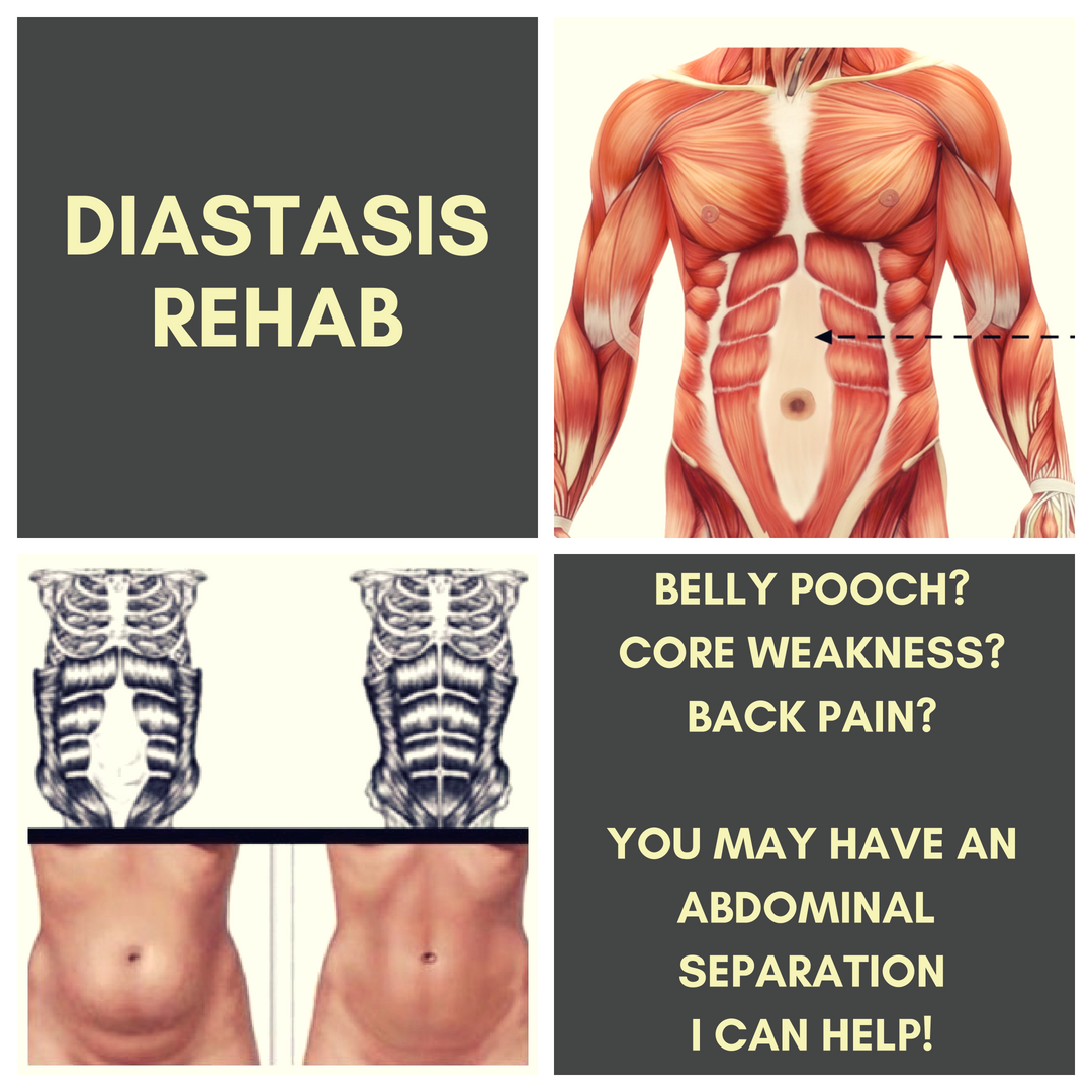 Diastasis Rehab