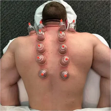 Therapeutic cupping session on upper back and shoulders at Massage Hope in Lansdowne (Leesburg/Ashburn VA)