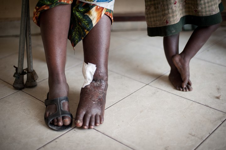 In the Kivus, an influx of war-wounded - Woman with gunshot wound, Goma, North Kivu - © ICRC/Moore, Phi