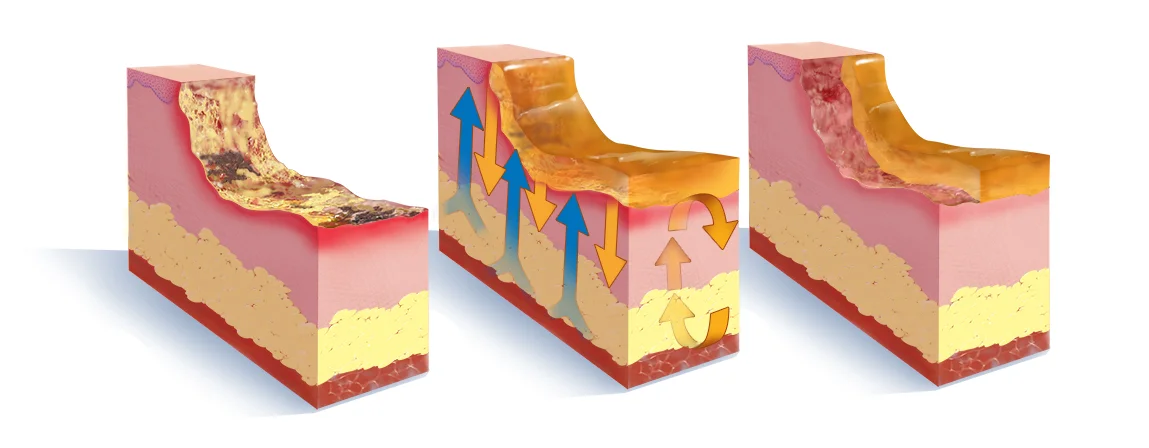 Stages of wound healing