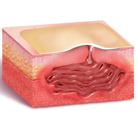 abscess5.jpg