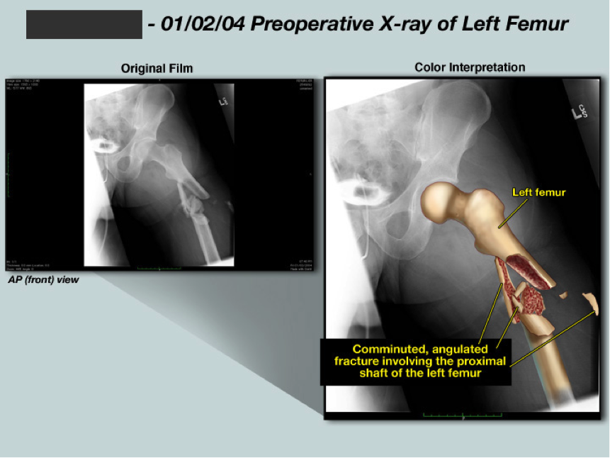 Medical legal: X-ray colorization