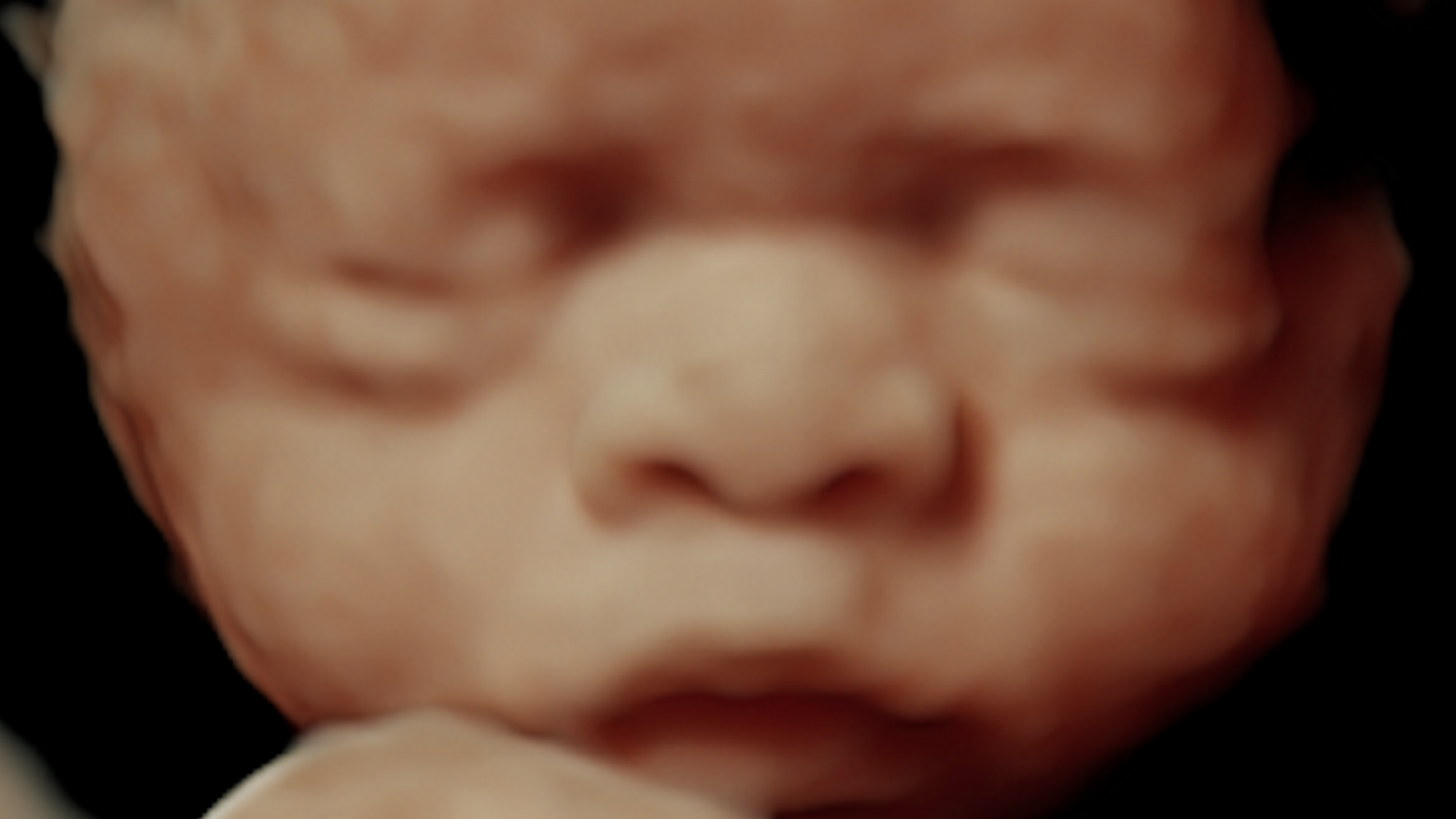 Sweet Peek Sonography Sweet Peek Sonography