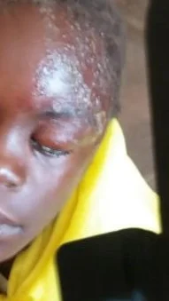 Typical shingles rash seen well demarcated around the eye