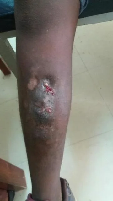 The affected leg