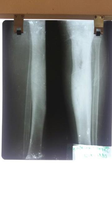 X-ray of both lower legs
