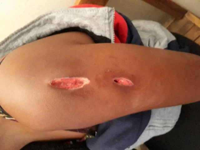ulcer.jpg