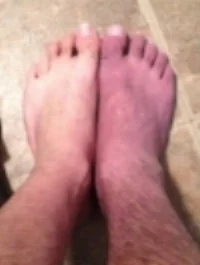 Jason's foot swollen and red before the Lightning Process
