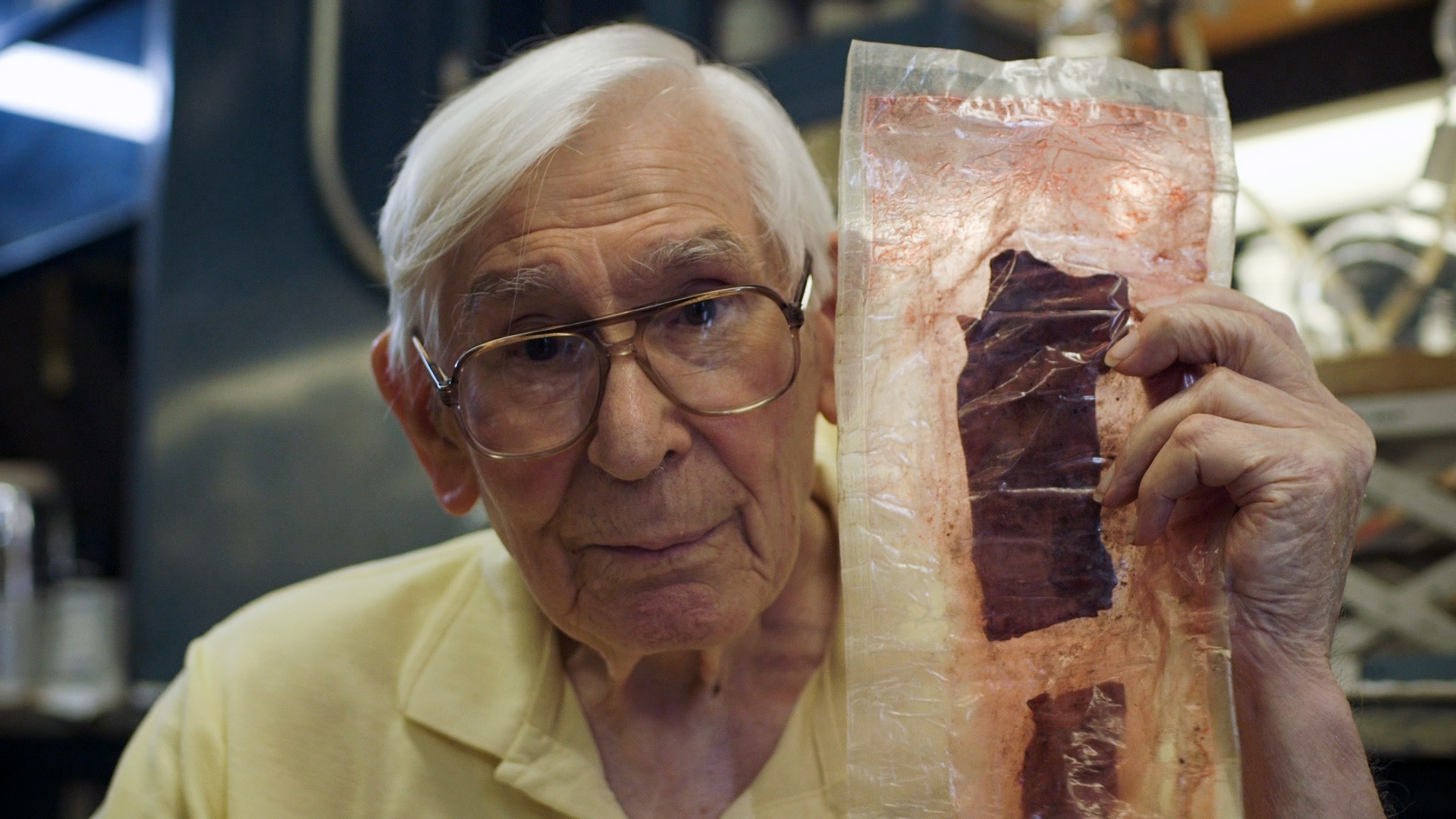 Hardened artery as a result of trans-fats and PUFAs