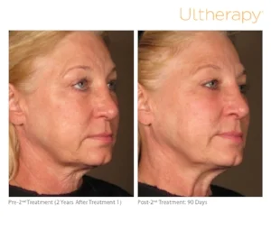 ultherapy-0108c-d_2yrposttx1before-90daysaftertx2_full.jpg