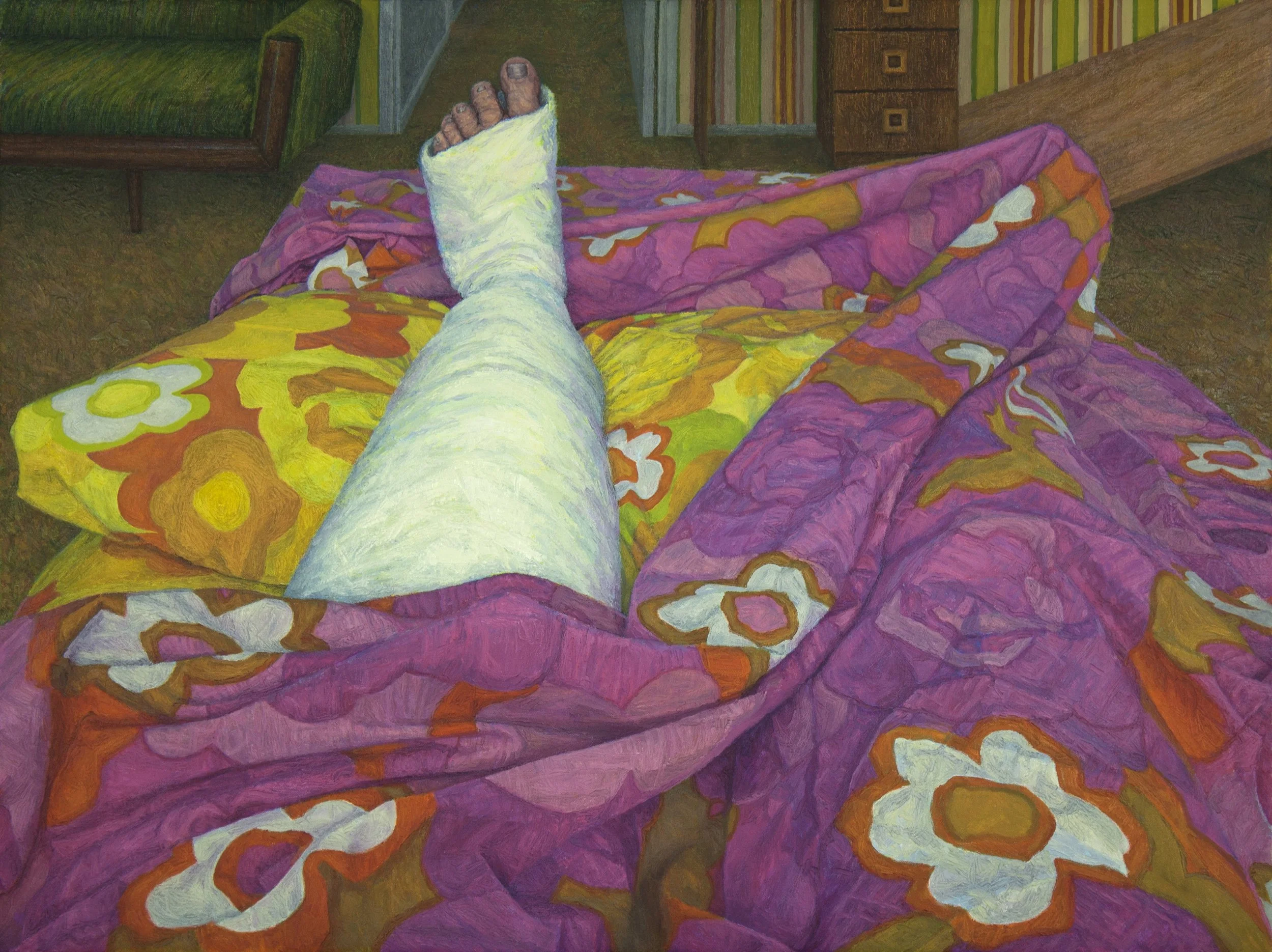 My Mother's Second Post-Polio Broken Leg