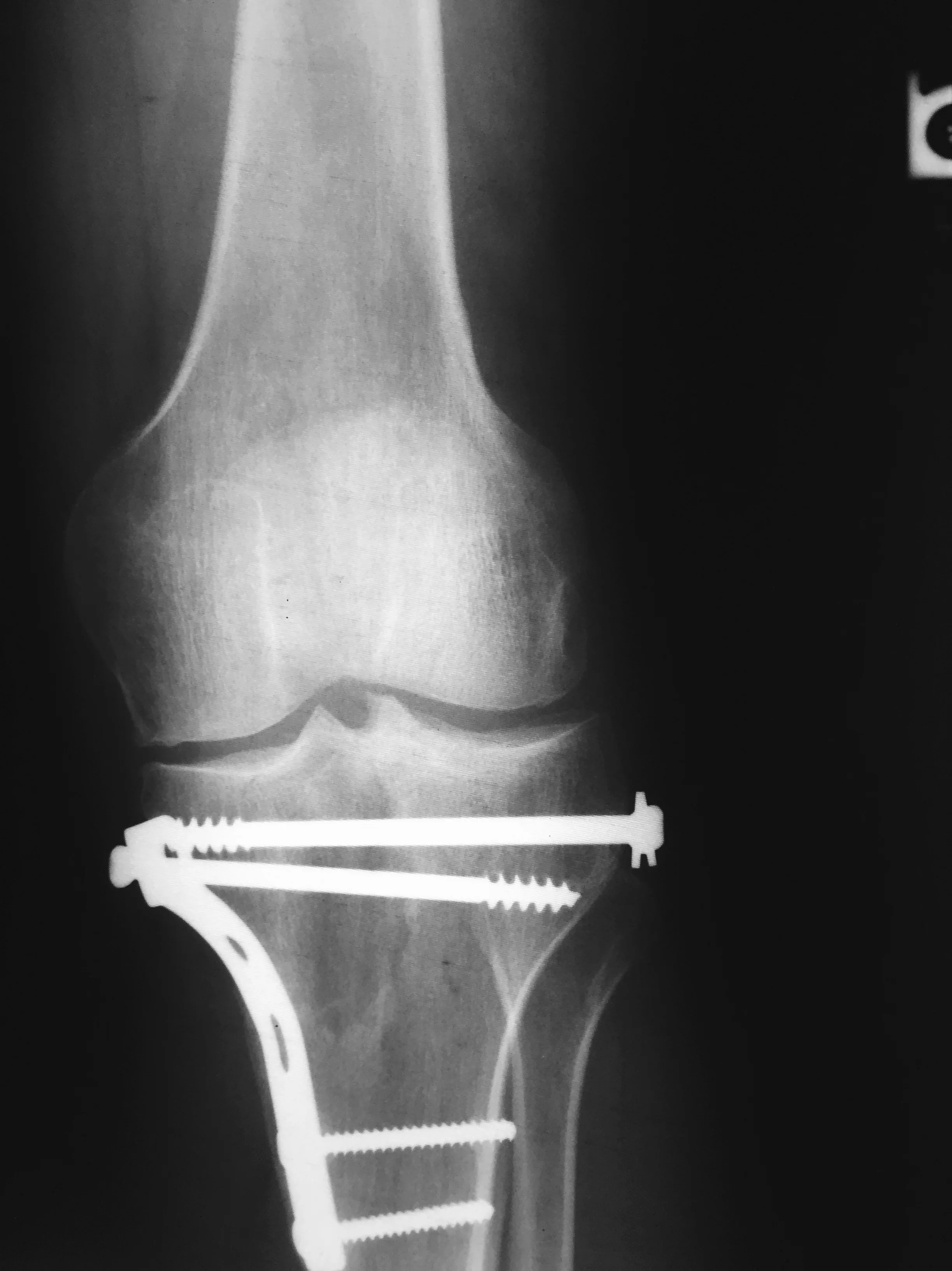 Recent MRI of my left knee