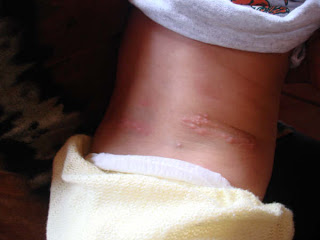 Her young son suffers from periodic outbreaks of rashes all over his body.