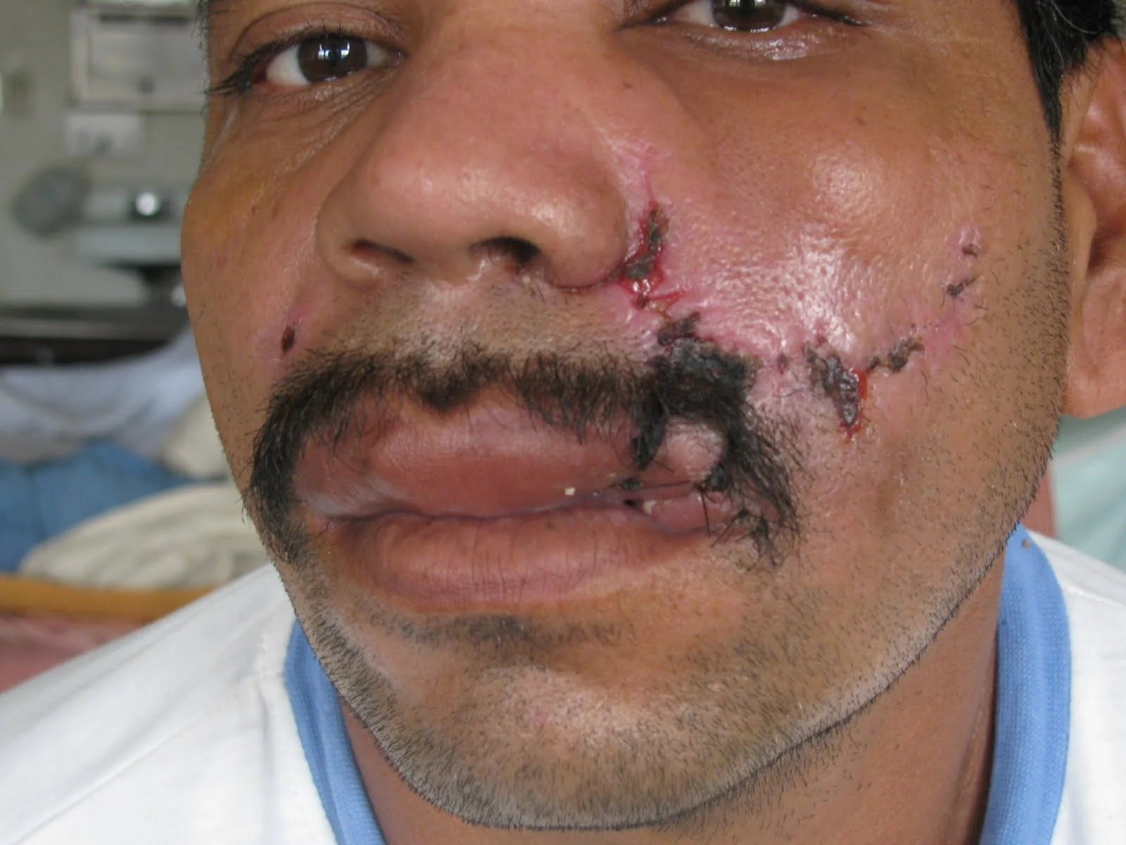 Campesino from MCA injured in the attack