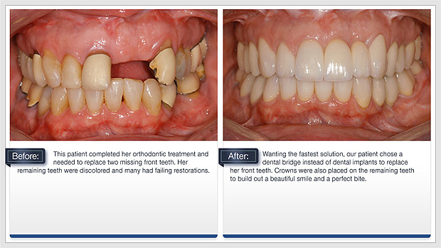 Replace Missing Front teeth with Tooth Colored filling, Implant or denture