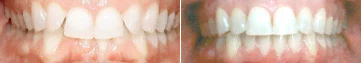 TEETH OVERBITE
