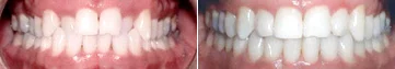 TEETH CROSSBITE