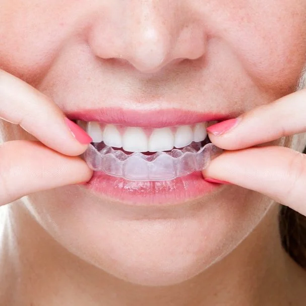 clear aligner invisalign alternative.jpg