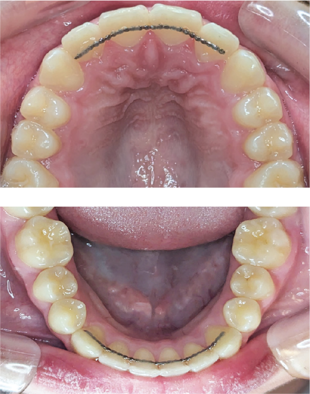 permanent bonded orthodontic retainer mansfield