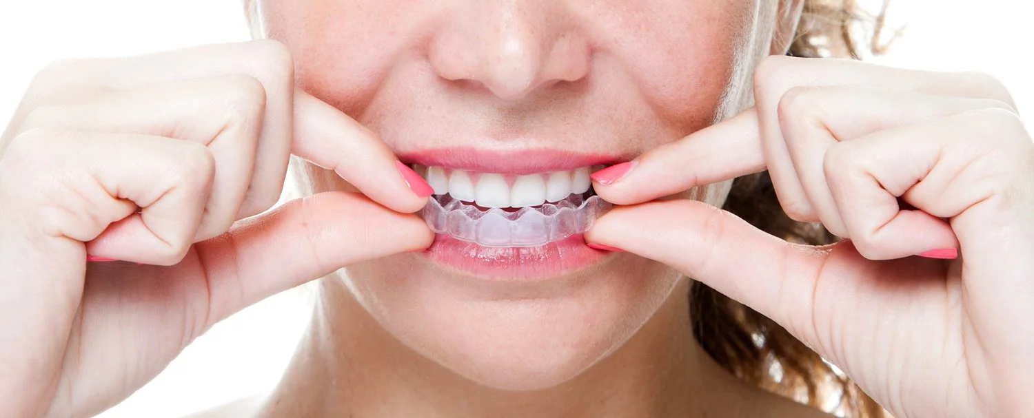 clear aligner invisalign alternative.jpg