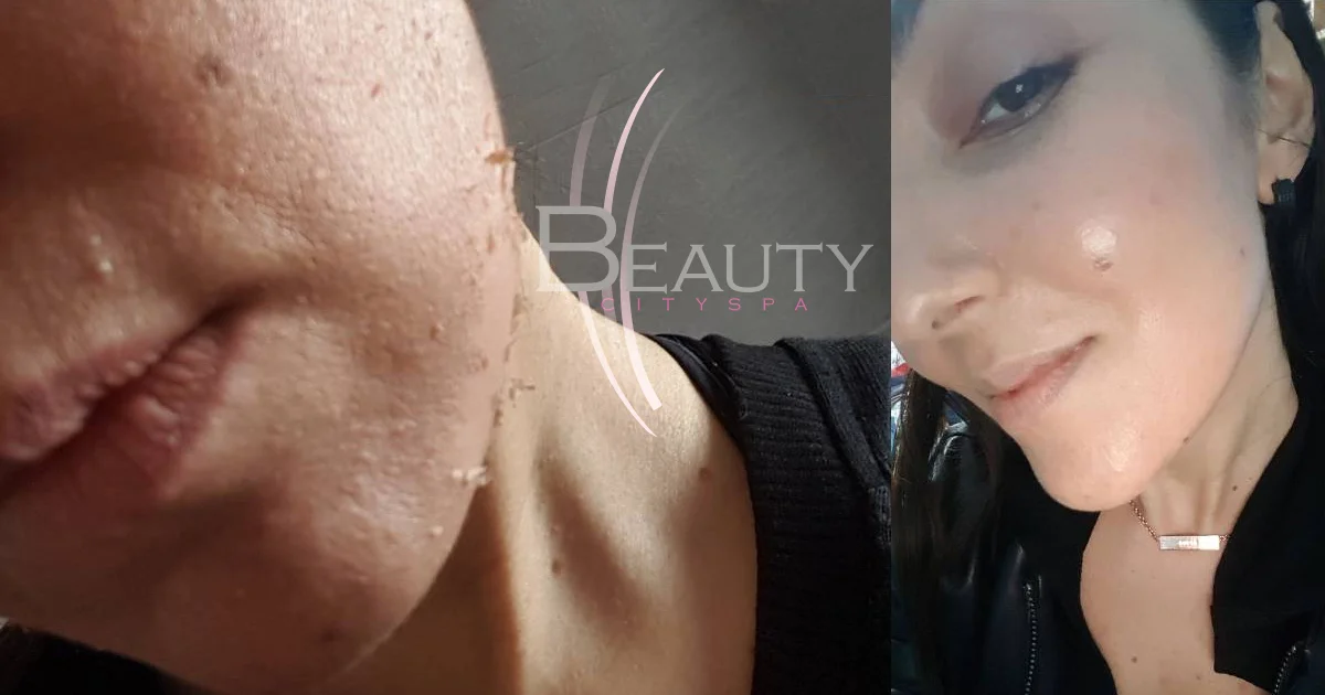Φυτικό Peeling