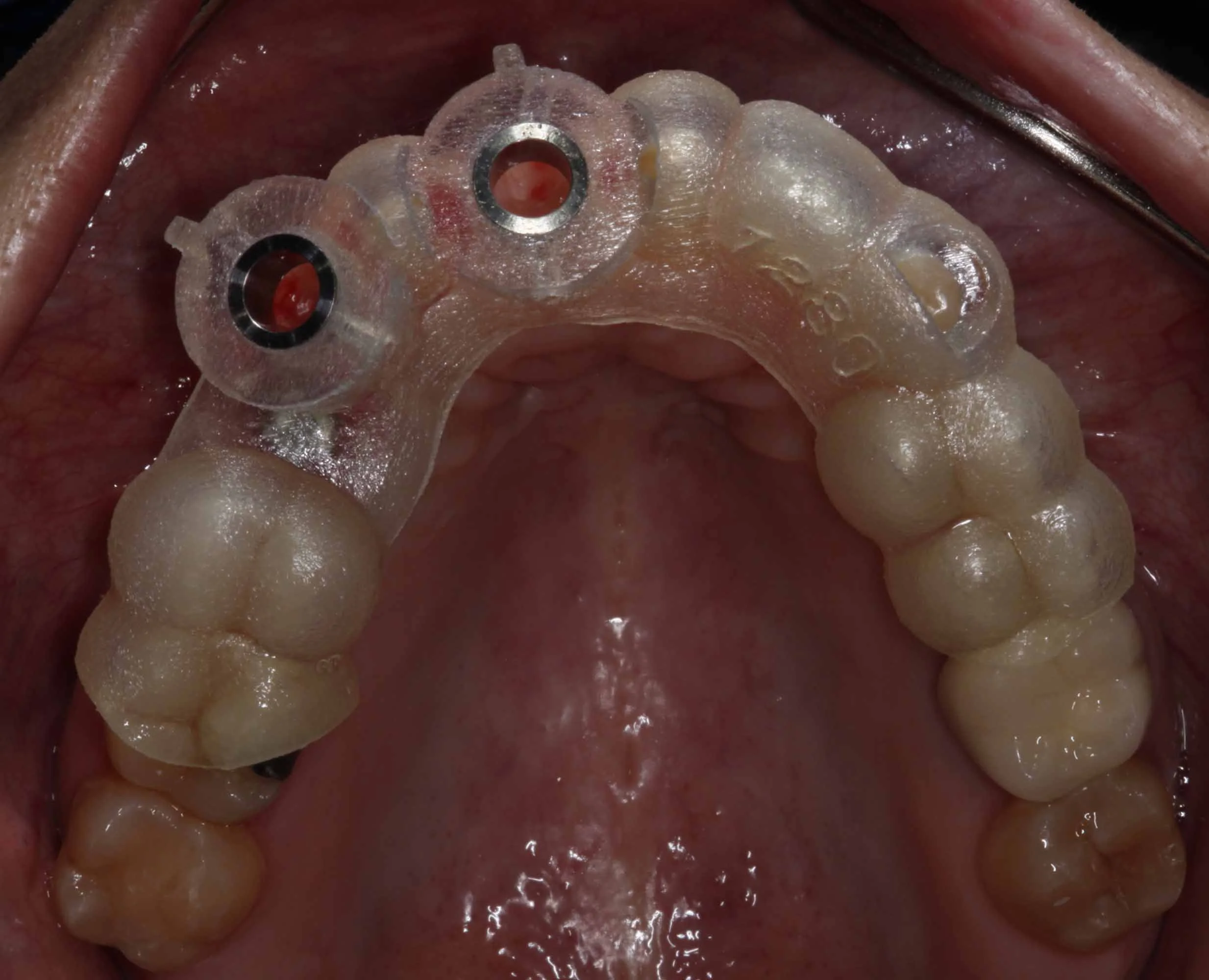 Guided Implant Surgery - The changing language of implant dentistry
