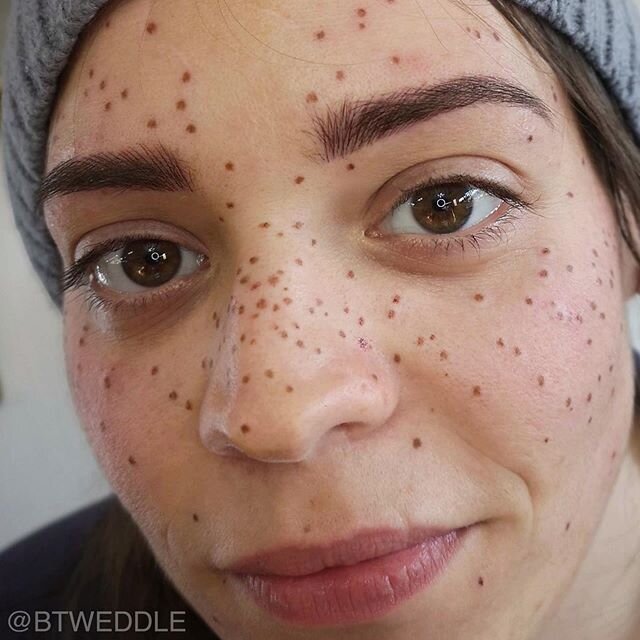 Healed tattooed freckles mingling happily with natural ones We added a  whole bunch more after taking these photos  Tattooed freckles Freckles  Cosmetic tattoo