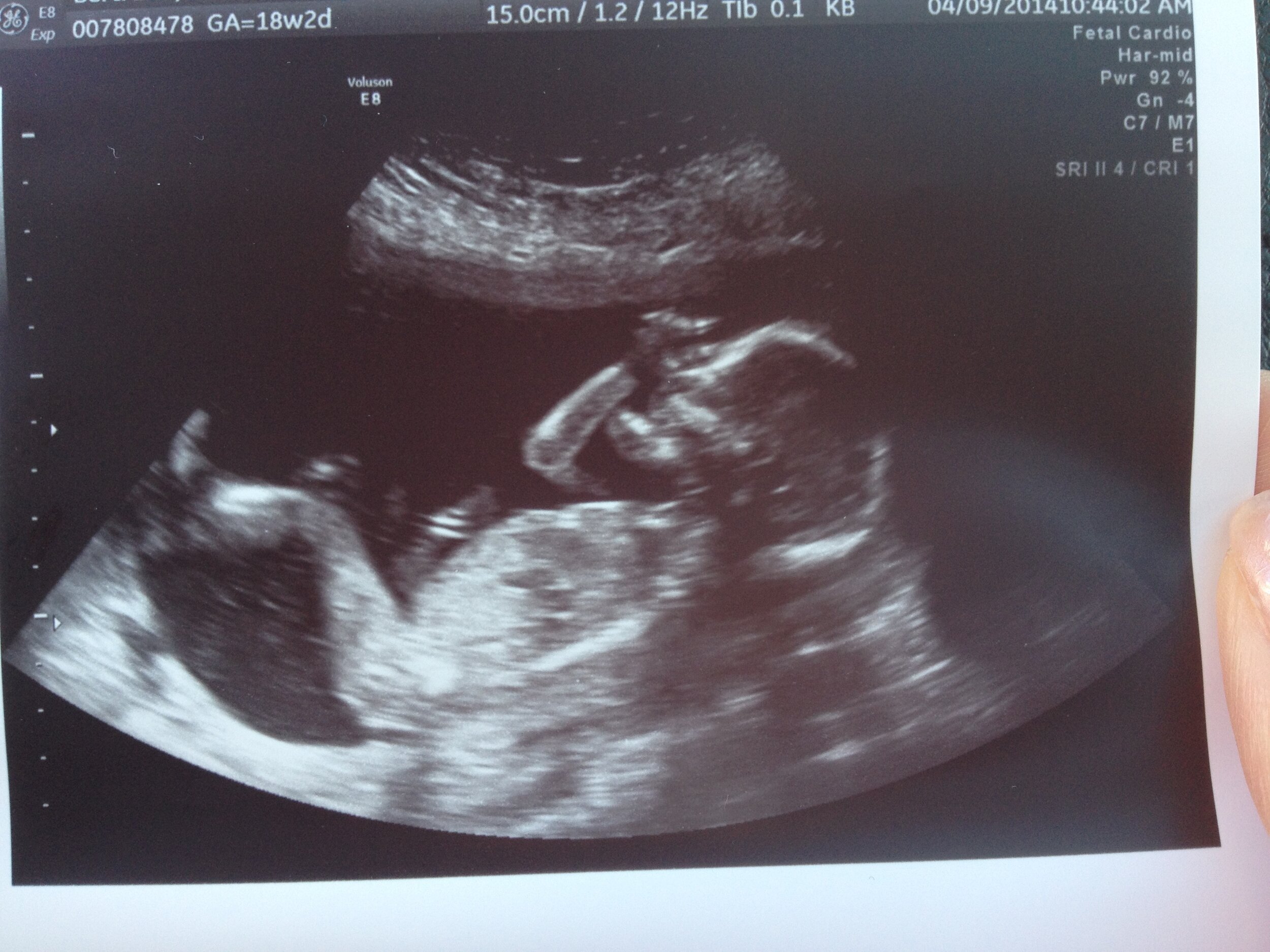 pregnancy ultrasound baby girl