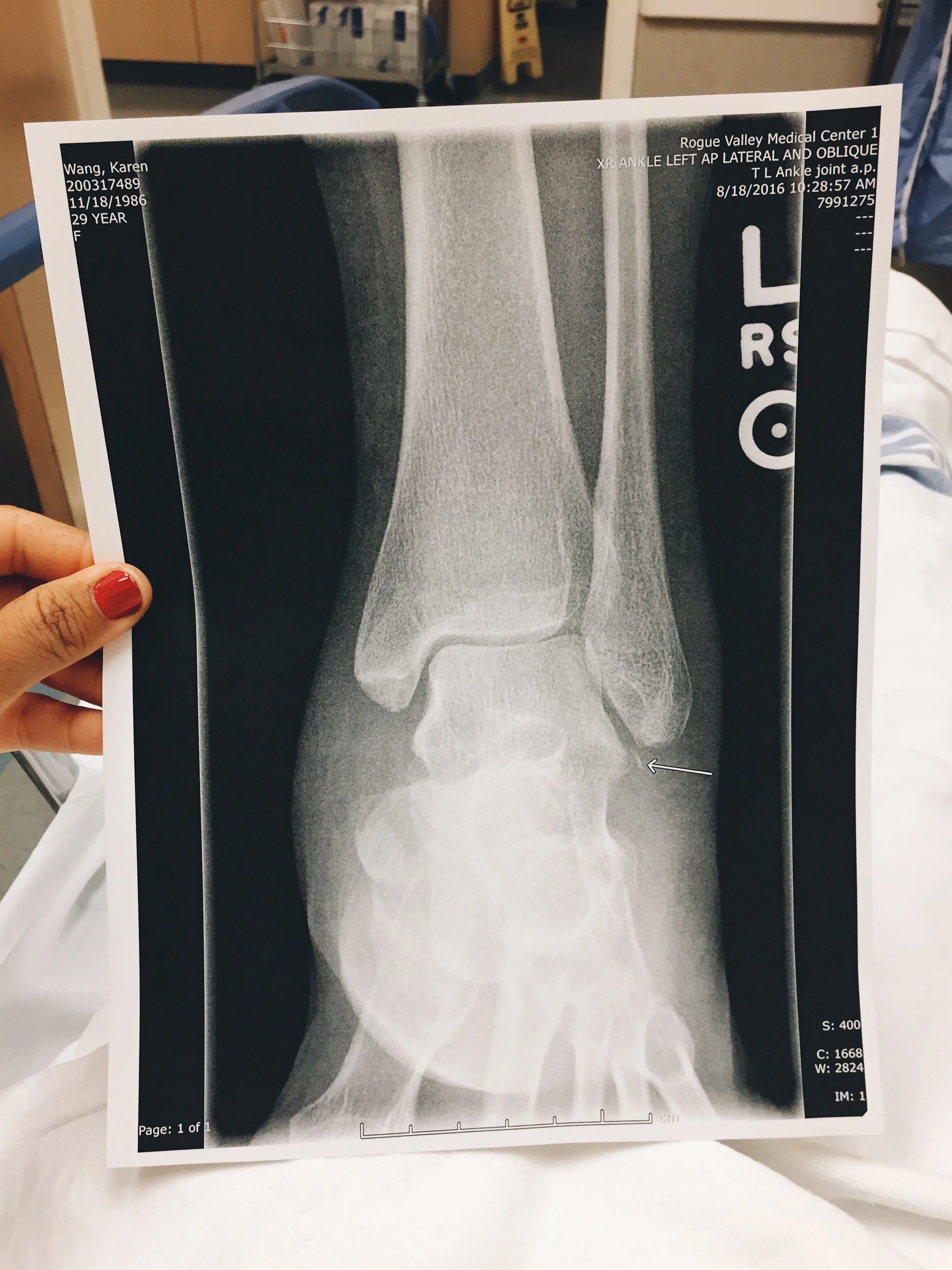 The avulsion fracture in my ankle. 
