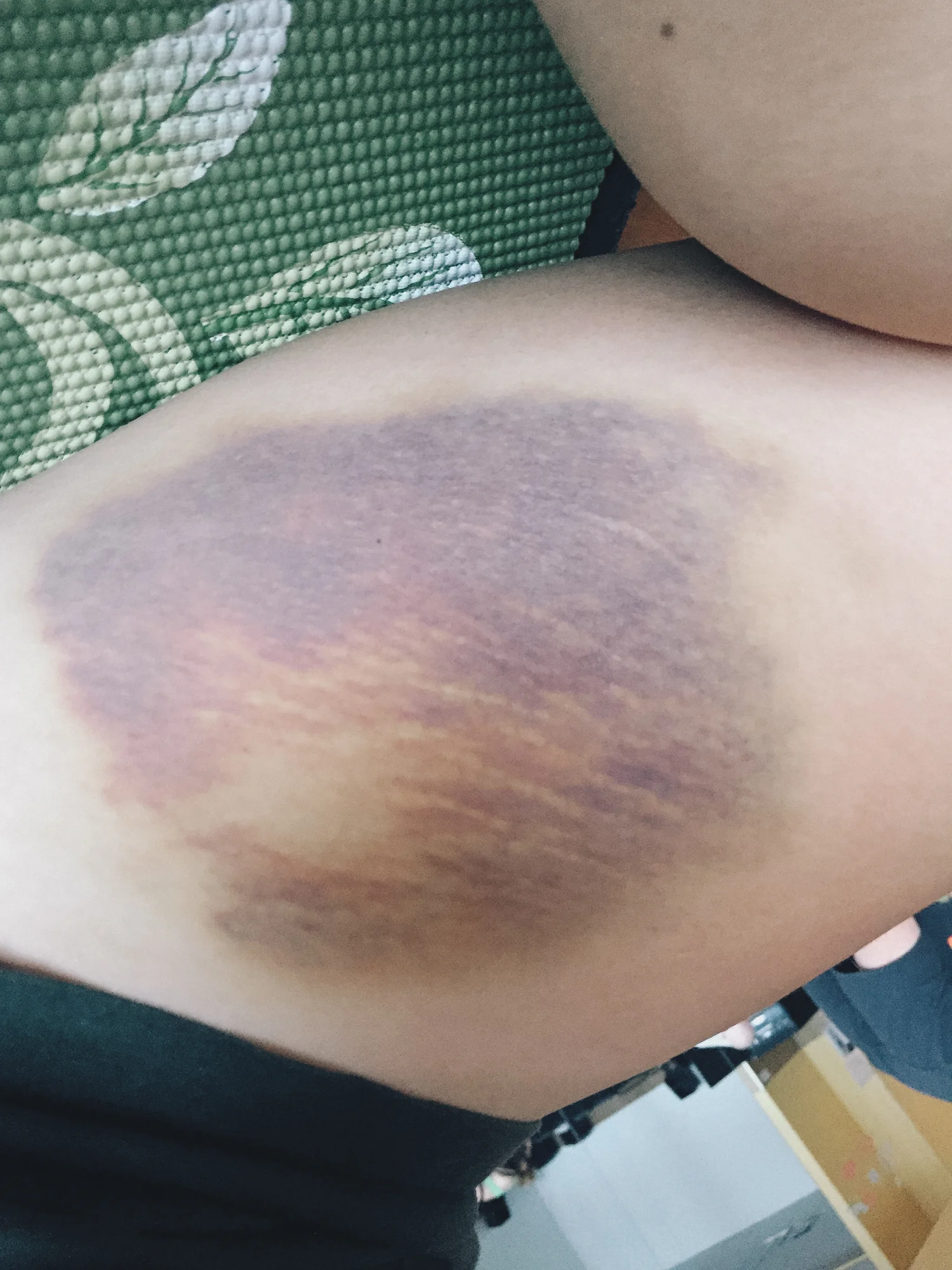 After Spire's prusik station. I got really bad bruising from the rope on my inner thigh. I also could not make it up the tree until our second week there.