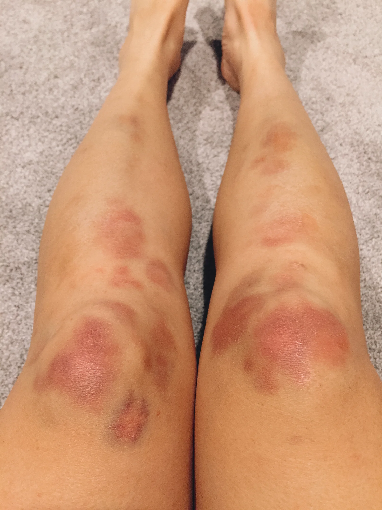 I also tore up my knees/shins bc I climbed w them bc it was the only way I could get up. I would not recommend that. But who cares, I just wanted to make it to the top.